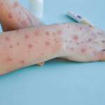 भिक्टोरियामा एमपोक्सको अहिलेसम्मकै ठूलो प्रकोप, एनएसडब्ल्यूमा पनि केसको संख्यामा वृद्धि