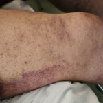 १८ औं शताब्दीको स्कर्वी रोग अस्ट्रेलियामा फेरि देखा पर्यो