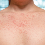 ब्रिस्बेन फर्किएका यात्रुमा Measles संक्रमण पुष्टि, सतर्कता अपनाउन आग्रह