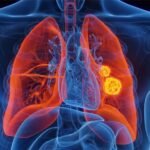 किन कहिल्यै चुरोट नपिउनेलाई पनि हुन्छ फोक्सोको क्यान्सर ?