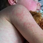 Brisbane–Gold Coast मा Measles Alert, कन्सर्ट र पर्यटन स्थलहरूमा संक्रमितको उपस्थिति रहेको पुष्टि
