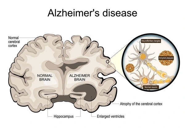 alzheimers-disease-neurodegeneration-cross-section-600nw-2472889481