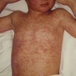 Western Australia भर Measles फैलिँदै, खोप अभियानलाई बलियो बनाउने स्वास्थ्य विभागको तयारी