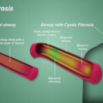 परिवारमा नभए पनि देखिन सक्ने Cystic Fibrosis: किन महत्वपूर्ण छ Genetic Screening?