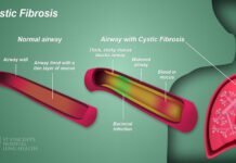 परिवारमा नभए पनि देखिन सक्ने Cystic Fibrosis: किन महत्वपूर्ण छ Genetic Screening?