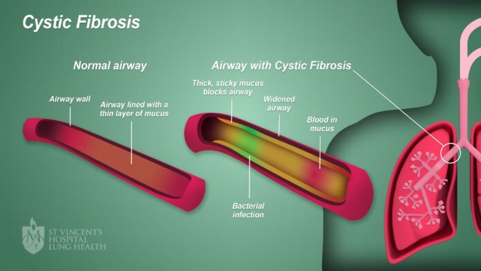 3_SVH_Lung_Health_Cystic_Fibrosis_final